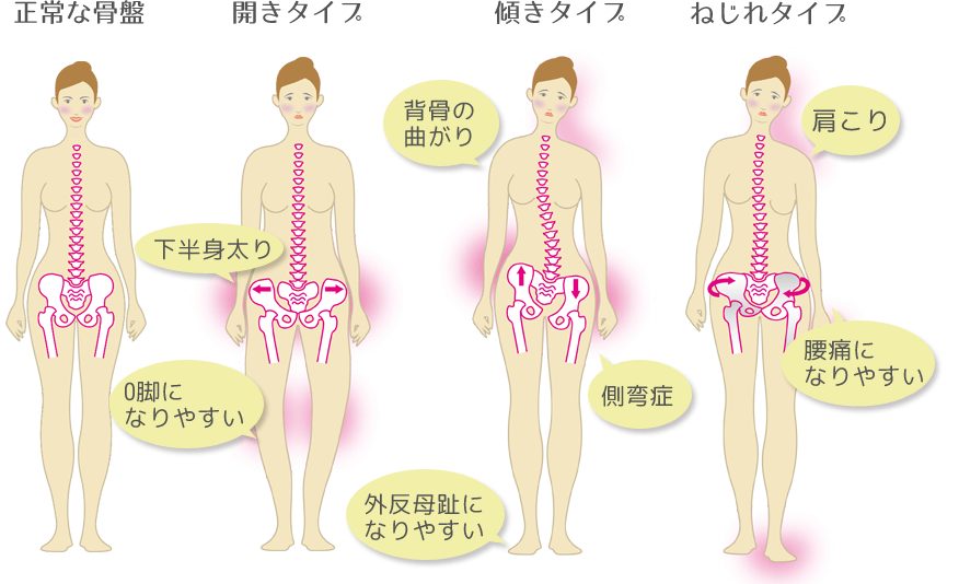 骨盤のバランス別タイプ