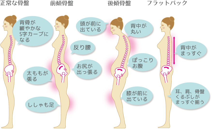 正常な骨盤以外に前傾骨盤、後傾骨盤、フラットバックのタイプがあります